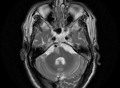 Foville Syndrome: Reading a Pontine Stroke From the Eyes and Face