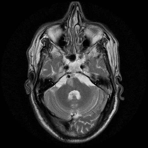 Foville Syndrome: Reading a Pontine Stroke From the Eyes and Face