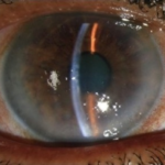 Clinical eye photograph illustrating Fuchs Endothelial Dystrophy Genetics