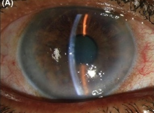Fuchs Endothelial Dystrophy: What the Genetics Tell Us About a Common Disease