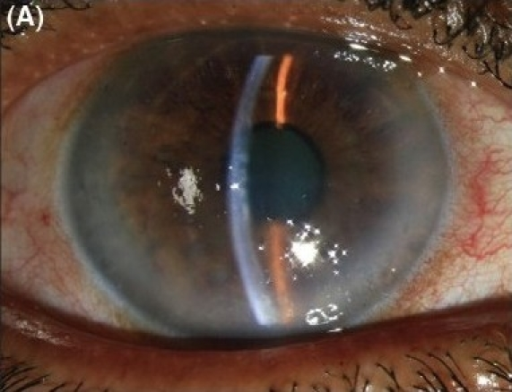 Clinical eye photograph illustrating Fuchs Endothelial Dystrophy Genetics