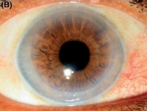 Clinical eye photograph illustrating Fuchs Endothelial Dystrophy Genetics