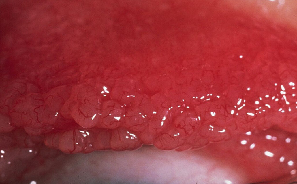 Giant Papillary Conjunctivitis: When Contact Lenses Turn Against the Eye