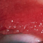 Giant papillary conjunctivitis: cobblestone papillae on the everted upper tarsal conjunctiva