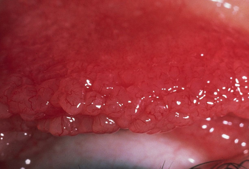 Giant papillary conjunctivitis: cobblestone papillae on the everted upper tarsal conjunctiva
