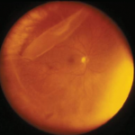 Giant retinal tear: fundus photograph showing a large tear with a detached retinal flap
