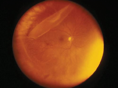 Giant Retinal Tear: When the Flap Folds Over Itself