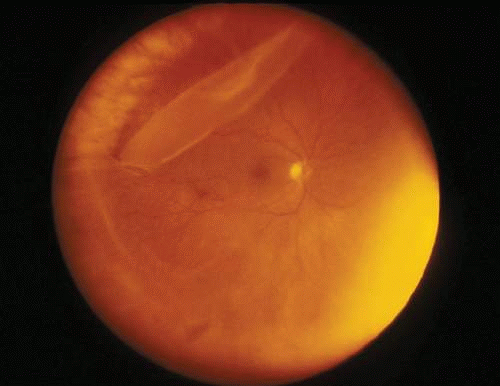 Giant Retinal Tear: When the Flap Folds Over Itself