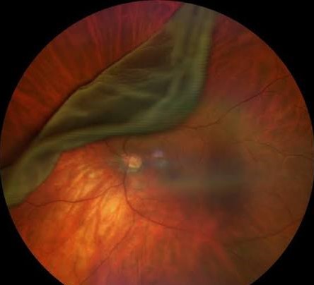 Giant retinal tear: folded posterior flap of retina extending across the fundus toward the optic disc
