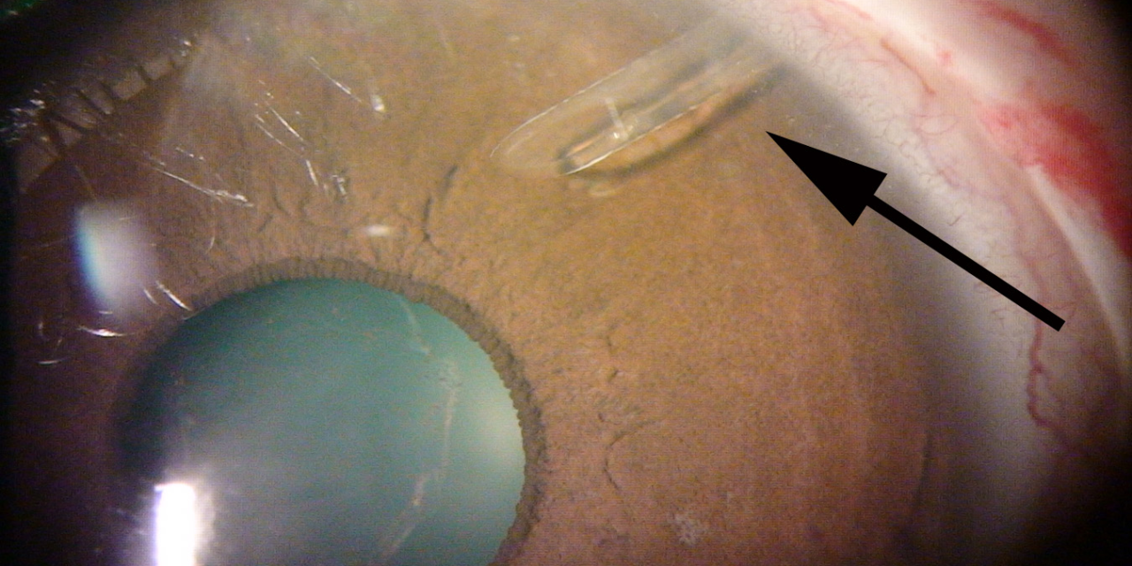 Glaucoma Drainage Devices: When the Tube Beats the Bleb
