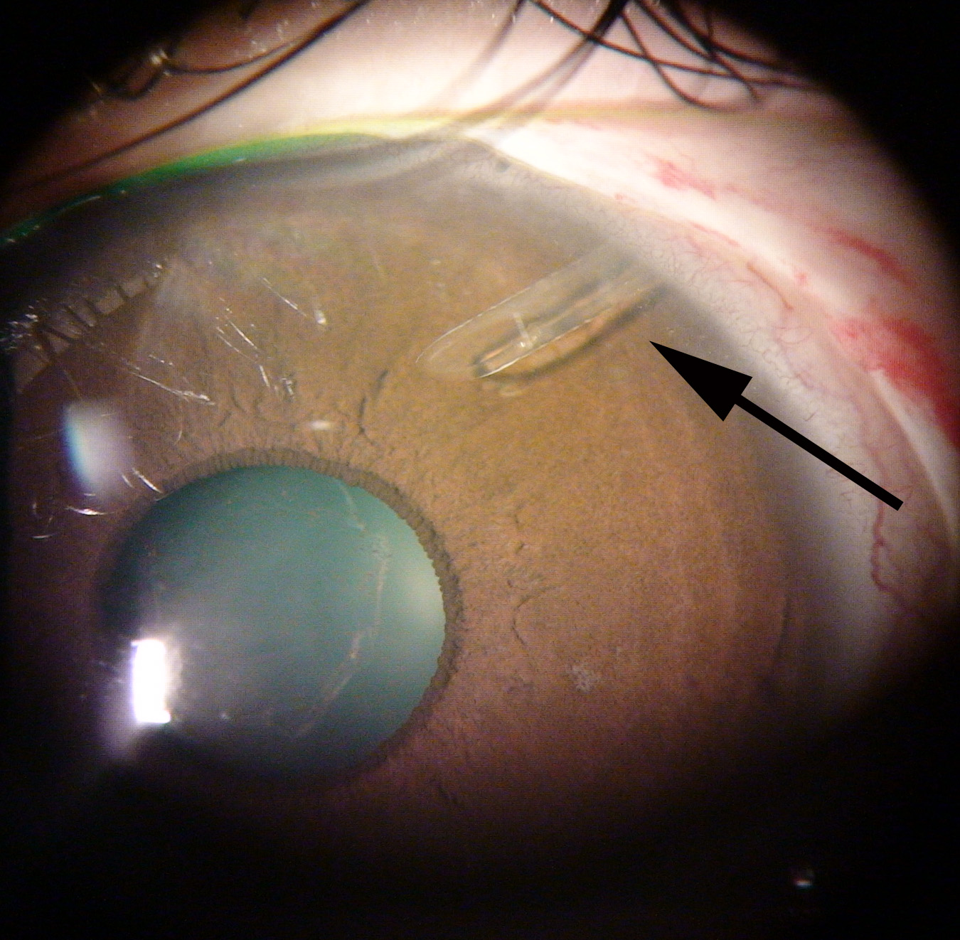 Glaucoma drainage device: tube entering the anterior chamber near the limbus (arrow)