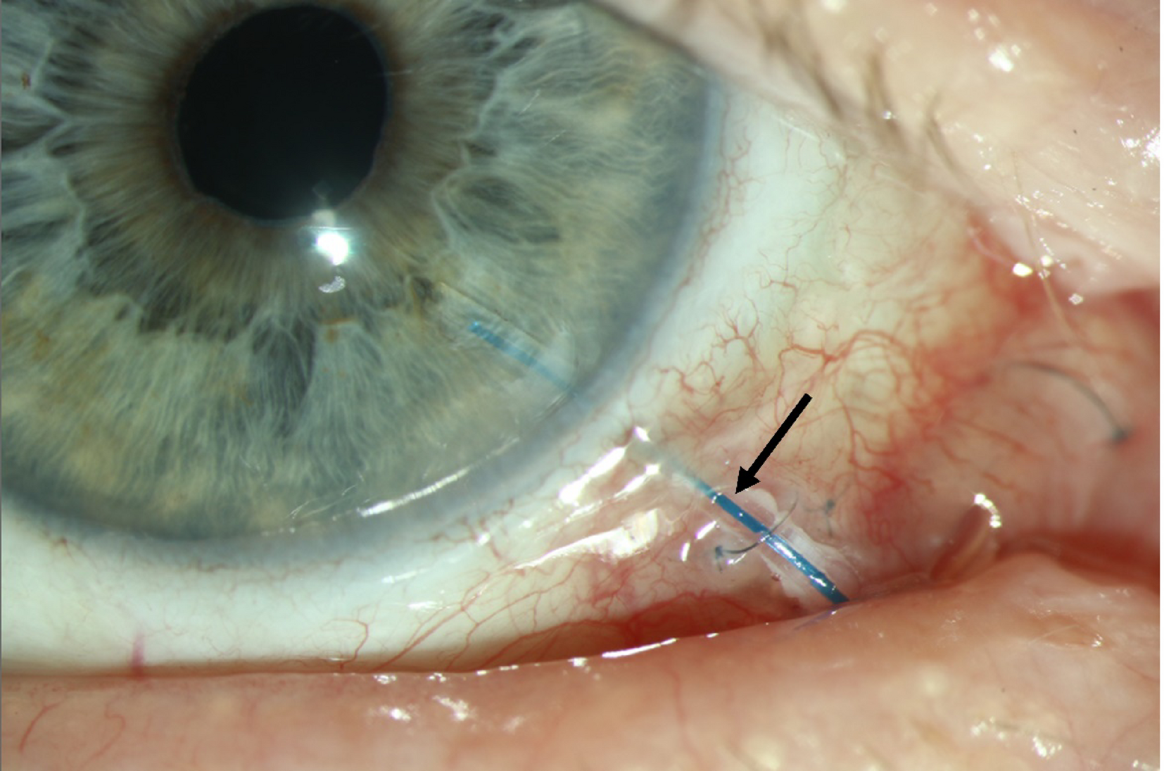 Glaucoma drainage device: tube passing over the limbus beneath the conjunctiva with a fixation suture (arrow)