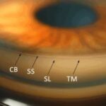 Gonioscopy: view of the anterior chamber angle showing the ciliary body band, scleral spur, and trabecular meshwork