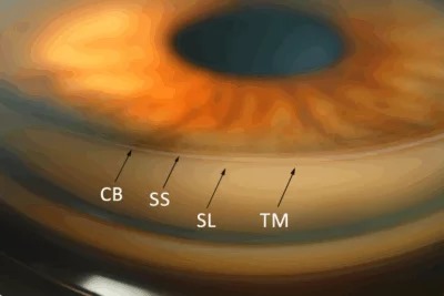Gonioscopy: Seeing the Angle That Slit-Lamp Exam Cannot