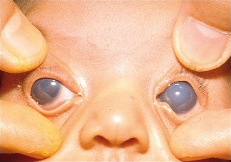Goniotomy: neonate with bilateral primary congenital glaucoma and hazy corneas