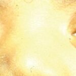 Goniotomy: infant with primary congenital glaucoma showing bluish hazy and enlarged corneas