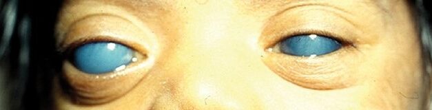 Goniotomy: Opening the Angle From Inside for Congenital Glaucoma