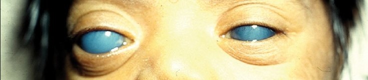 Goniotomy: Opening the Angle From Inside for Congenital Glaucoma