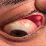 Floppy Eyelid Syndrome