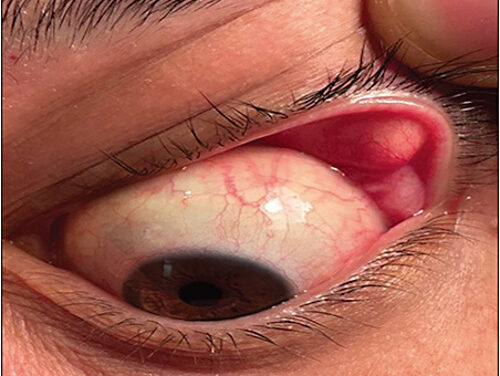 Floppy Eyelid Syndrome: The Sleep Apnea Connection
