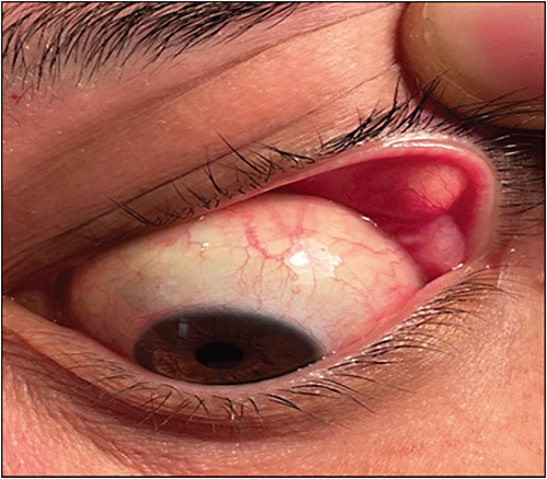 Floppy Eyelid Syndrome: The Sleep Apnea Connection