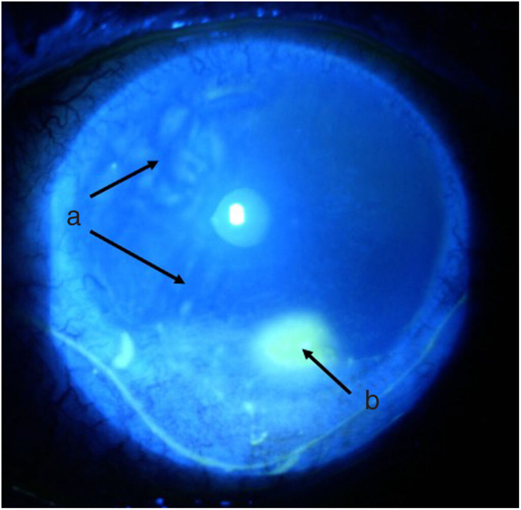 Corneal Melt
