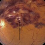 Hemi-central retinal vein occlusion: fundus photograph showing retinal hemorrhages, cotton wool spots, and dilated tortuous veins in one half of the retina