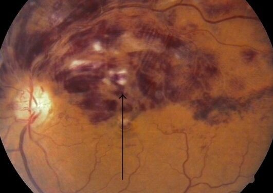 Hemi-Central Retinal Vein Occlusion: The Variant Between Branch and Central