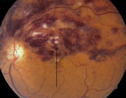 Hemi-Central Retinal Vein Occlusion Fundus Hemorrhages Hemi-central retinal vein occlusion: fundus photograph showing retinal hemorrhages, cotton wool spots, and dilated tortuous veins in one half of the retina