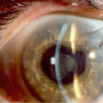 Clinical eye photograph illustrating Hla B27 Anterior Uveitis Systemic Workup