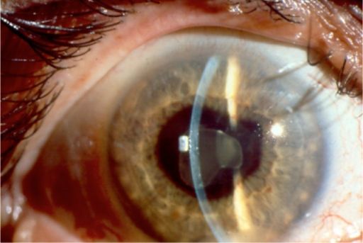 HLA-B27 Anterior Uveitis: Recurrent, Unilateral, and a Reason to Ask About the Back