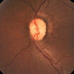 Homonymous hemianopia: fundus photograph showing optic disc pallor consistent with retrograde degeneration