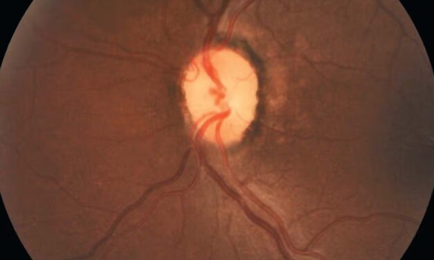 Homonymous Hemianopia: What Congruity Tells You About the Lesion