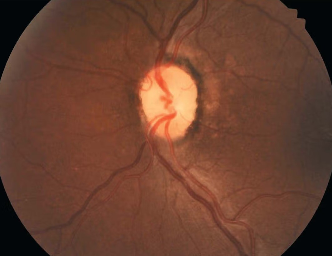 Homonymous Hemianopia Optic Disc Fundus Homonymous hemianopia: fundus photograph showing optic disc pallor consistent with retrograde degeneration