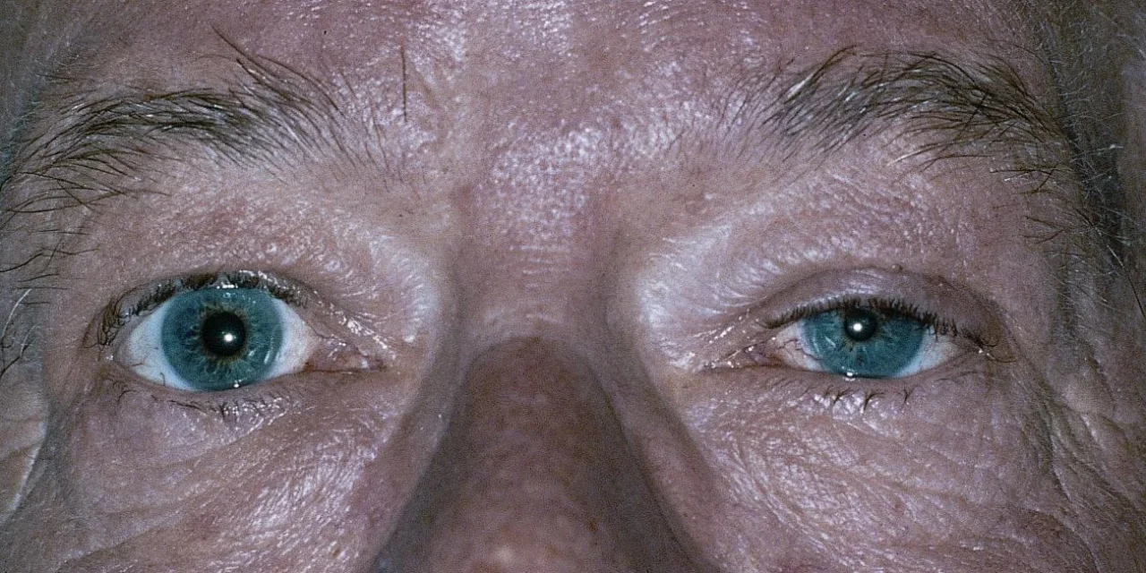 Horner Syndrome: Three Neurons, Three Very Different Emergencies