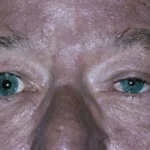 Horner syndrome: close-up of both eyes showing miosis and mild ptosis of the right eye compared with the left