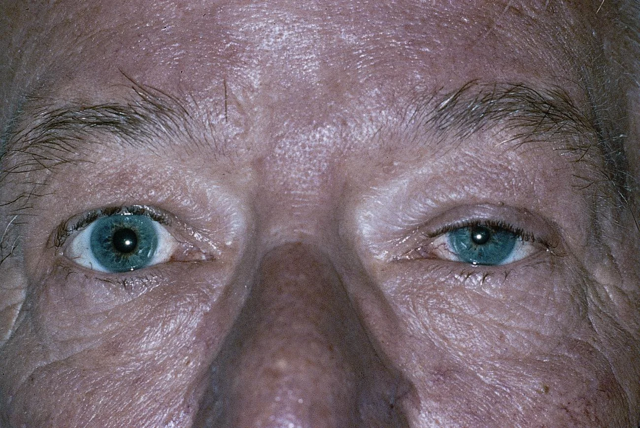 Horner Syndrome Miosis and Ptosis Horner syndrome: close-up of both eyes showing miosis and mild ptosis of the right eye compared with the left