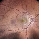 Hypertensive choroidopathy: fundus photograph showing a focal chorioretinal lesion consistent with an Elschnig spot