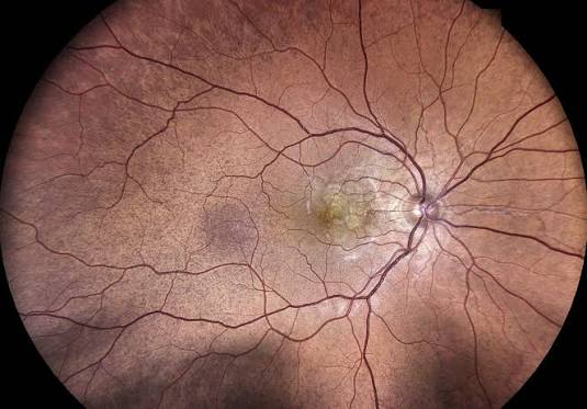 Hypertensive Choroidopathy: When the Vessel That Can’t Autoregulate Fails