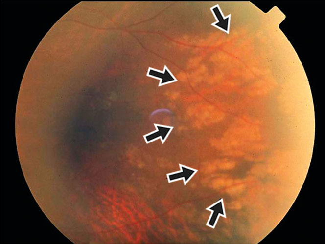 Hypertensive Choroidopathy Triangular Infarct Hypertensive choroidopathy: fundus photograph with arrows marking a triangular area of choroidal infarction