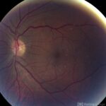 Talc Retinopathy