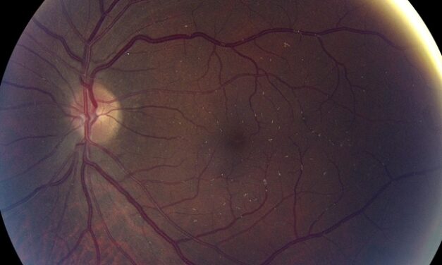 Talc Retinopathy: A Fundus Finding That Reveals IV Drug Use
