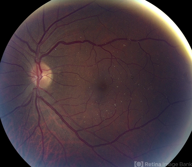 Talc Retinopathy