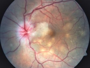 Ocular Tuberculosis