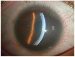 Congenital Hereditary Endothelial Dystrophy