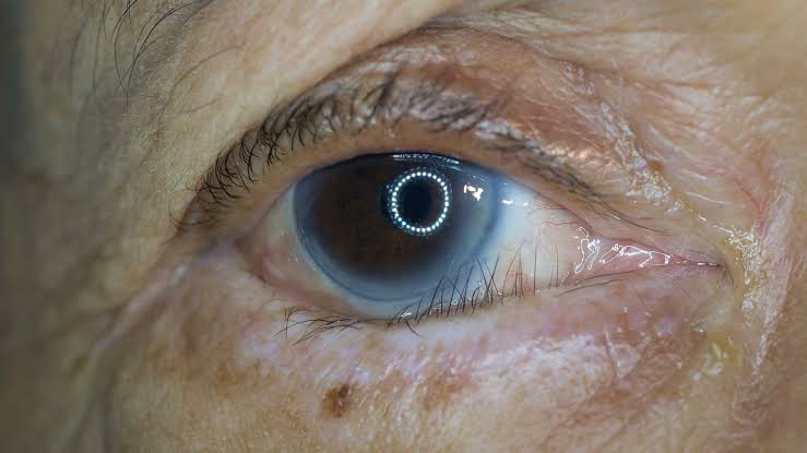 Entropion: Involutional, Cicatricial, Spastic, or Congenital?