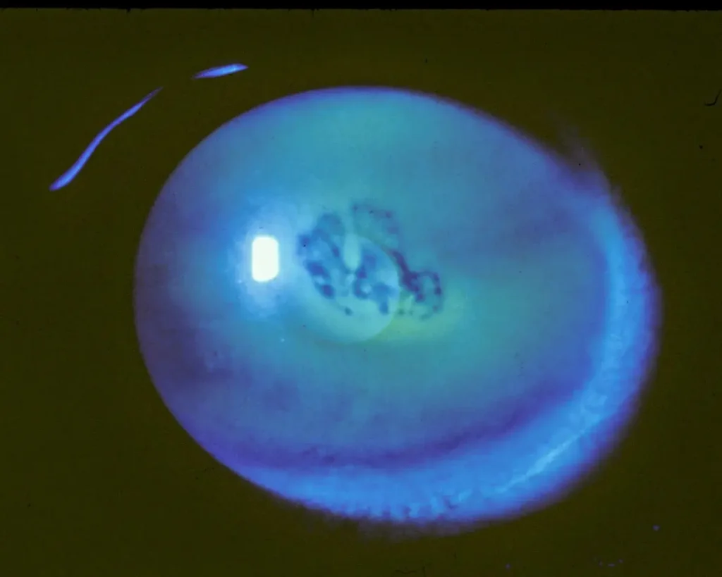 Recurrent Corneal Erosion