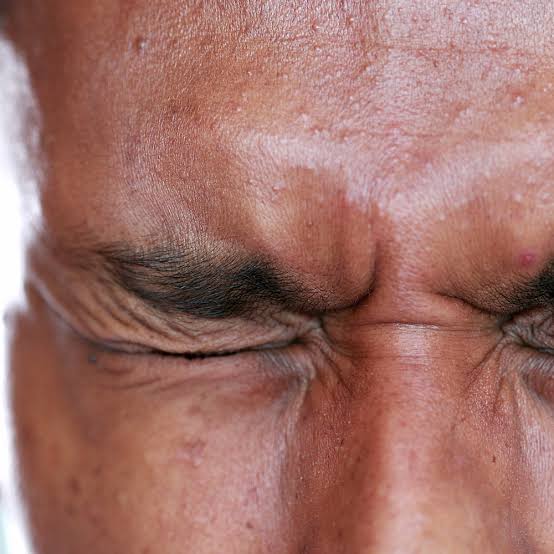 Essential Blepharospasm: A Neurologic Disease That Presents as an Eye Problem