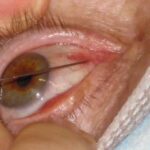 Botulinum Toxin for Strabismus