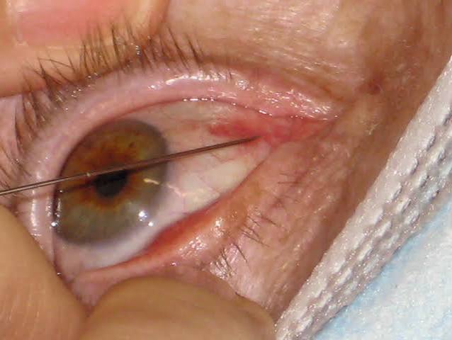 Botulinum Toxin for Strabismus
